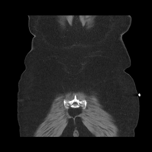 Acute cholecystitis with tensile fundus sign (Radiopaedia 71394-81723 Coronal non-contrast 111).jpg