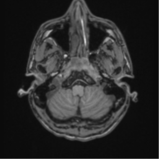 Acute disseminated encephalomyelitis (ADEM) (Radiopaedia 65319-74349 Axial T1 5).png