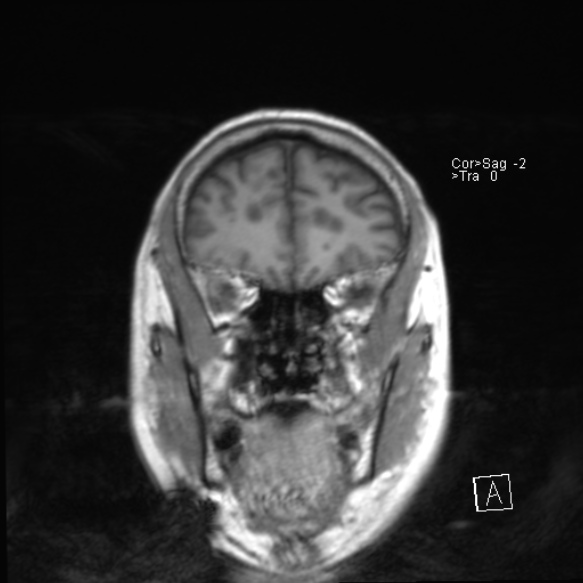 File:Acute disseminated encephalomyelitis (Radiopaedia 37253-39033 Coronal T1 8).jpg