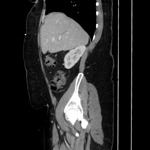 Acute diverticulitis - transverse colon (Radiopaedia 87063-103327 Sagittal C+ portal venous phase 82).jpg