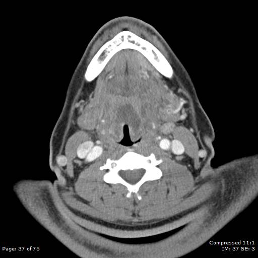 File:Acute epiglottitis (Radiopaedia 54375-60590 Axial C+ arterial phase 37).jpg