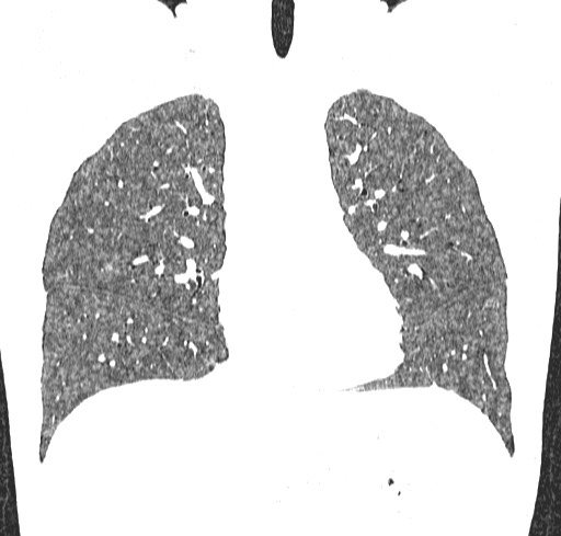 File:Acute hypersensitivity pneumonitis (Radiopaedia 85293-100870 Coronal lung window 51).jpg