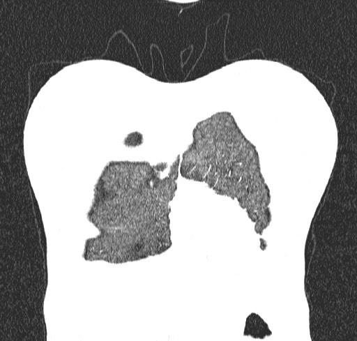 Acute hypersensitivity pneumonitis (Radiopaedia 85293-100870 Coronal lung window 6).jpg