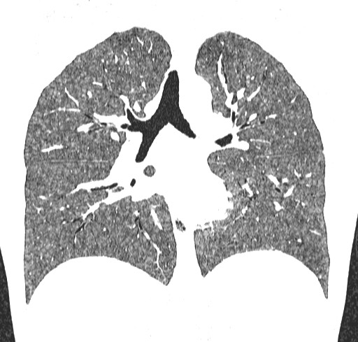Acute hypersensitivity pneumonitis (Radiopaedia 85293-100870 Coronal lung window 72).jpg