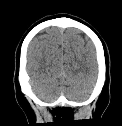 Acute internal carotid artery dissection (Radiopaedia 53541-59558 Coronal non-contrast 64).jpg