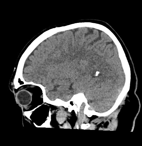 Acute internal carotid artery dissection (Radiopaedia 53541-59558 Sagittal non-contrast 19).jpg