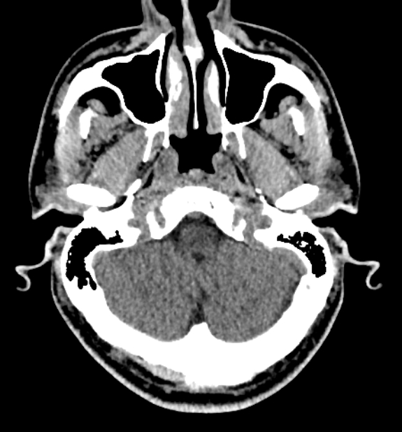 Acute ischemic stroke - posterior circulation territory (Radiopaedia 77670-89881 non-contrast 12).jpg