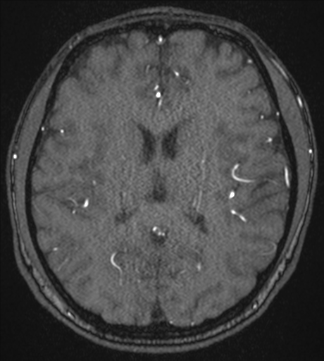Acute left middle cerebral artery territory infarct with clot retrieval (Radiopaedia 47732-52433 Axial MRA 38).png