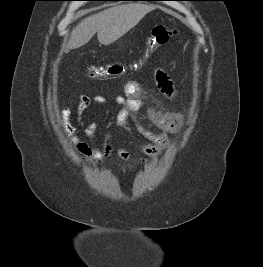 Acute mesenteric venous ischemia (Radiopaedia 46041-50383 Coronal C+ portal venous phase 19).jpg