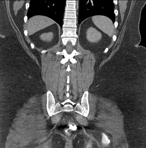 Acute mesenteric venous ischemia (Radiopaedia 46041-50383 Coronal C+ portal venous phase 76).jpg