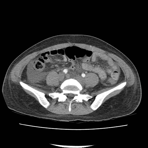 Acute myocarditis (Radiopaedia 55988-62613 Axial C+ portal venous phase 51).jpg