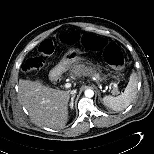 File:Acute pancreatic necrosis (Radiopaedia 13560-13486 Axial C+ portal venous phase 45).jpg