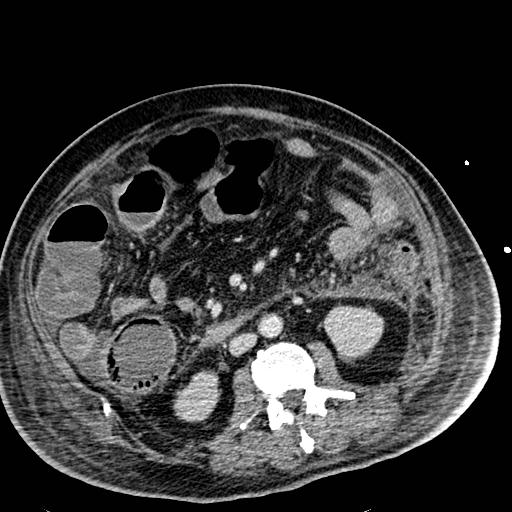 Acute pancreatic necrosis (Radiopaedia 13560-18501 Axial C+ portal venous phase 74).jpg