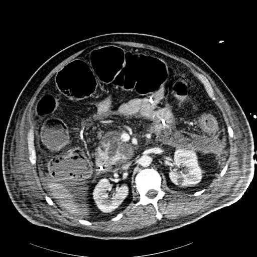 Acute pancreatic necrosis (Radiopaedia 13560-18502 Axial C+ portal venous phase 35).jpg