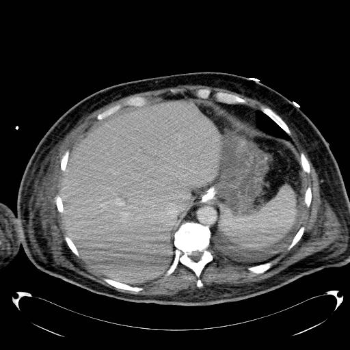 File:Acute pancreatic necrosis (Radiopaedia 13560-18503 Axial C+ portal venous phase 12).jpg