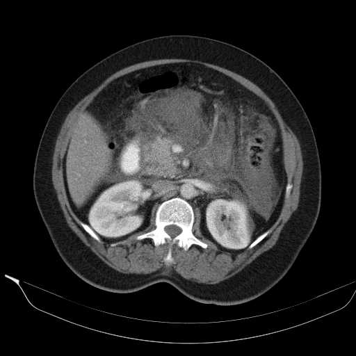 File:Acute pancreatitis (Radiopaedia 20829-20744 Axial C+ portal venous phase 19).jpg