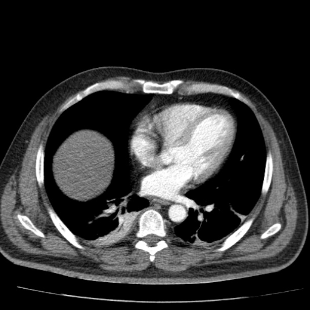 Acute pancreatitis (Radiopaedia 26663-26813 Axial C+ arterial phase 8).jpg