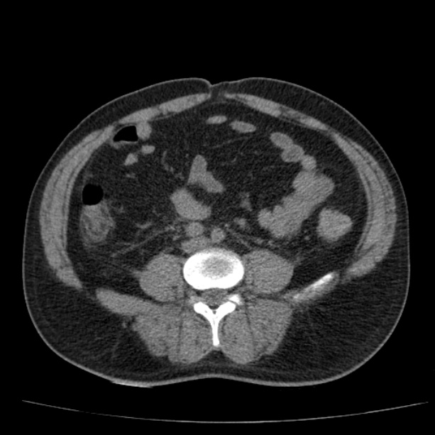 Acute pancreatitis (Radiopaedia 26663-26813 Axial non-contrast 64).jpg