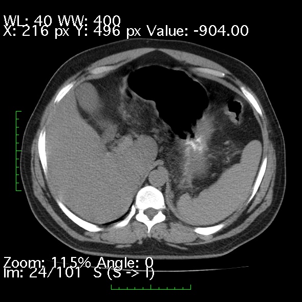 Acute pancreatitis (Radiopaedia 34043-35276 Axial non-contrast 24).jpg
