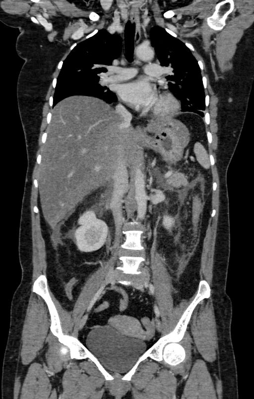 Acute pancreatitis (Radiopaedia 80007-93285 Coronal C+ portal venous phase 64).jpg