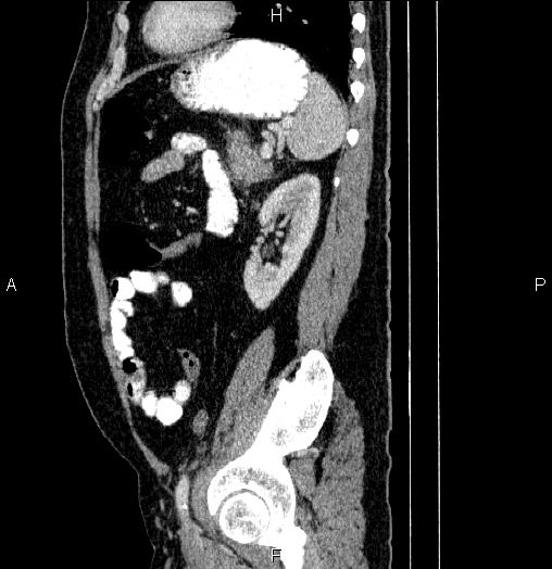 Acute pancreatitis (Radiopaedia 85390-101010 Sagittal C+ portal venous phase 75).jpg