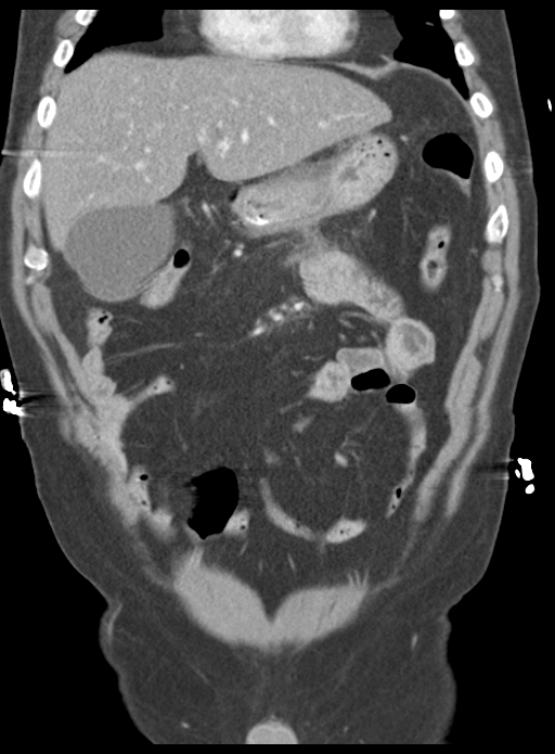 Acute pancreatitis complicated by portal vein thrombus (Radiopaedia 48148-52990 Coronal C+ portal venous phase 22).png