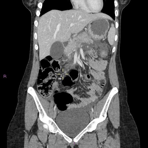 File:Acute pancreatitis secondary to stone at minor papilla and pancreatic divisum (Radiopaedia 76570-88333 Coronal C+ portal venous phase 13).jpg