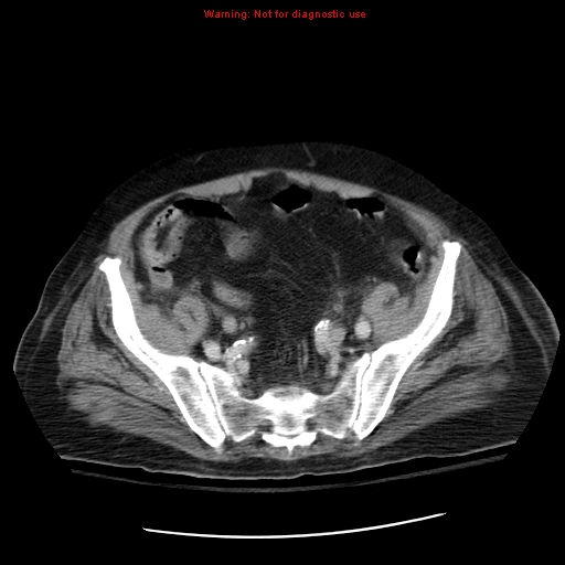 File:Acute pancreatitis with incidental pancreatic lipoma (Radiopaedia 10190-10730 Axial C+ portal venous phase 62).jpg