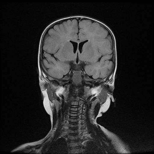 File:Acute phase of hemiconvulsion-hemiplegia epilepsy syndrome (Radiopaedia 29309-29745 Coronal FLAIR 10).jpg