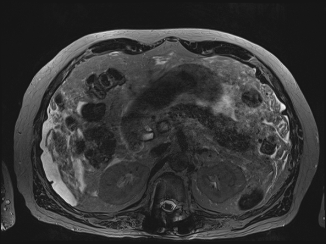 Acute portal vein thrombosis (Radiopaedia 73198-83925 Axial Heavily T2 thin cuts 36).jpg