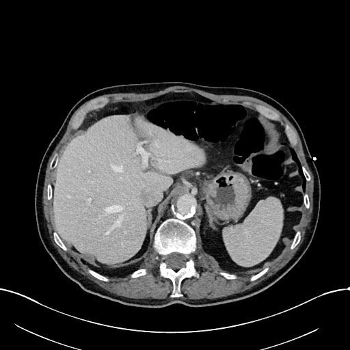 Acute renal infarction (Radiopaedia 59375-66736 Axial C+ portal venous phase 19).jpg