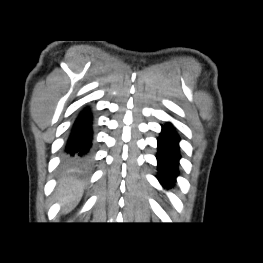 Acute segmental pulmonary emboli and pulmonary infarction (Radiopaedia 62264-70444 Coronal C+ CTPA 53).jpg