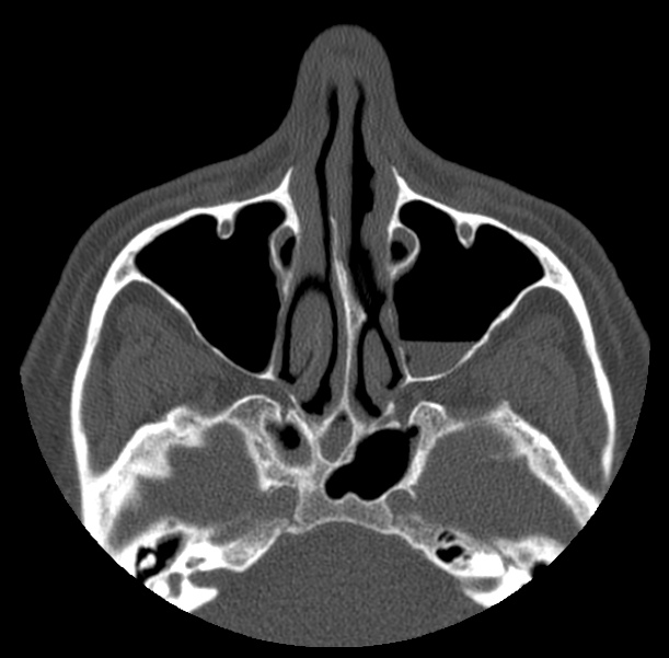 Acute sinusitis (Radiopaedia 23161-23215 Axial bone window 28).jpg