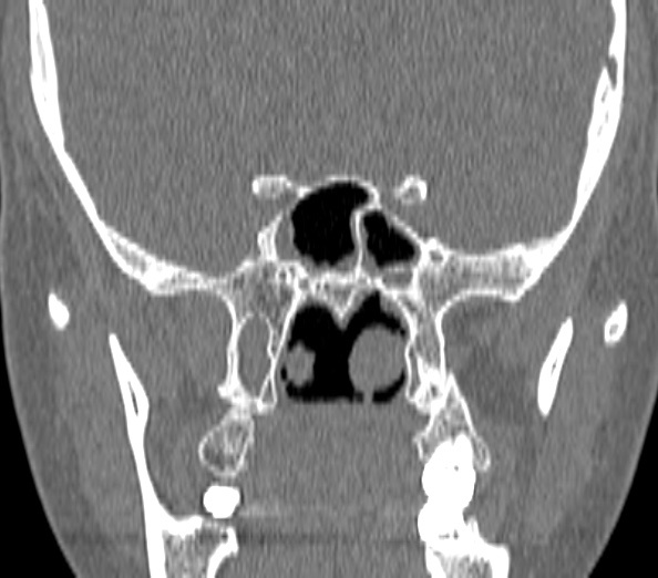 Acute sinusitis (Radiopaedia 40564-43158 Coronal bone window 35).jpg