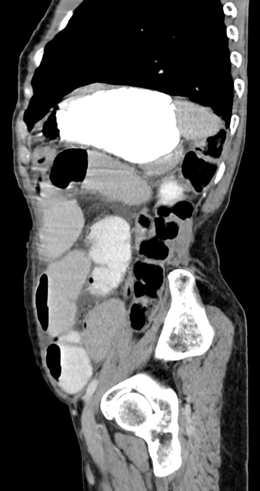 Acute small bowel (ileal) volvulus (Radiopaedia 71740-82139 Sagittal C+ portal venous phase 53).jpg