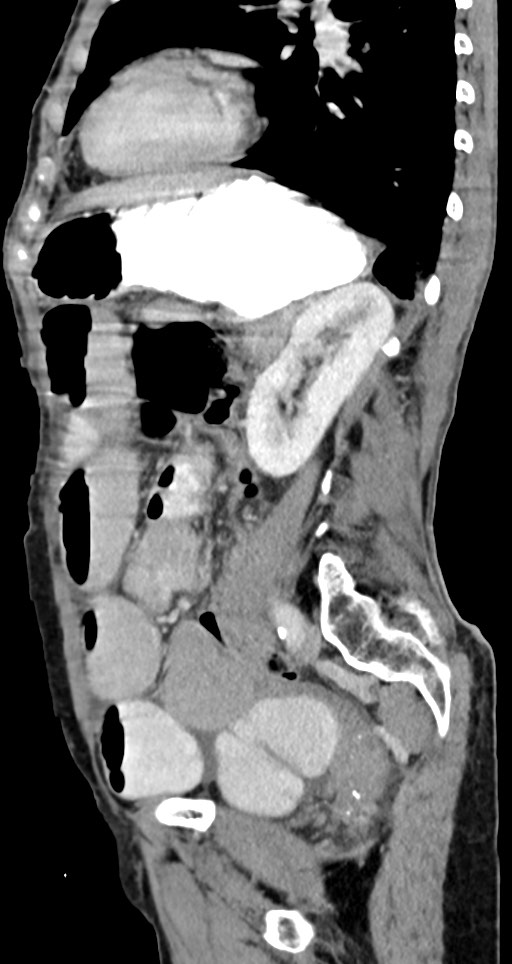 Acute small bowel (ileal) volvulus (Radiopaedia 71740-82139 Sagittal C+ portal venous phase 66).jpg