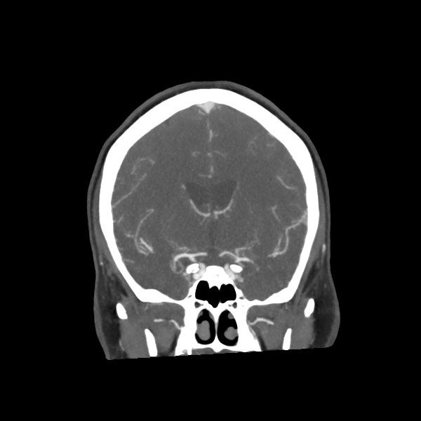 Acute subarachnoid hemorrhage and accessory anterior cerebral artery (Radiopaedia 69231-79009 Coronal C+ arterial phase 36).jpg