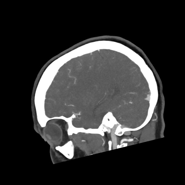 Acute subarachnoid hemorrhage and accessory anterior cerebral artery (Radiopaedia 69231-79009 Sagittal C+ arterial phase 23).jpg