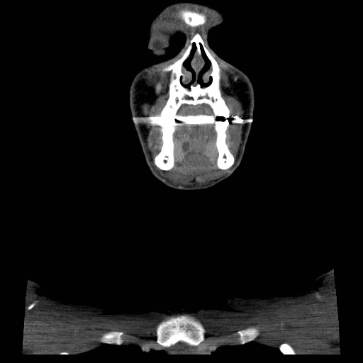 File:Acute submandibular sialadenitis secondary to ductal stone (Radiopaedia 27999-28267 D 11).jpg