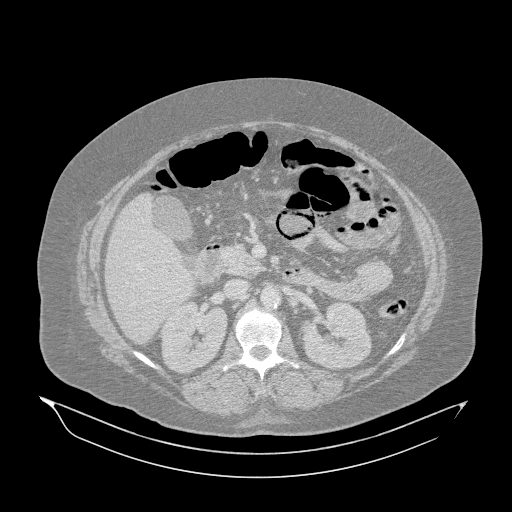 File:Acute superior mesenteric artery occlusion (Radiopaedia 51288-56960 Axial lung window 18).jpg