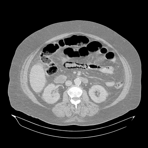 Acute superior mesenteric artery occlusion (Radiopaedia 51288-56960 Axial lung window 26).jpg