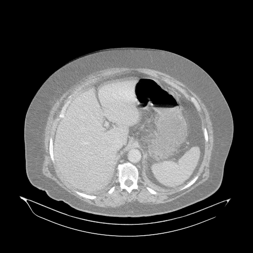 File:Acute superior mesenteric artery occlusion (Radiopaedia 51288-56960 Axial lung window 3).jpg