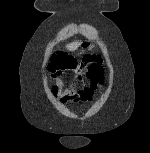 File:Acute superior mesenteric artery occlusion (Radiopaedia 51288-56960 Coronal C+ portal venous phase 10).jpg