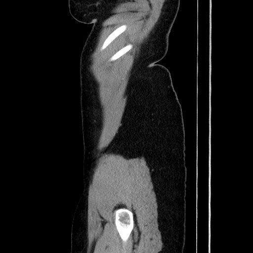 Acute uncomplicated appendicitis (Radiopaedia 73704-84499 Sagittal C+ portal venous phase 46).jpg