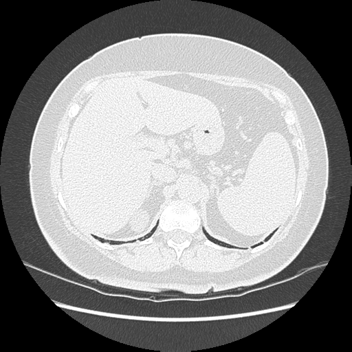Adenocarcinoma in situ of lung (Radiopaedia 38685-40829 B 216).png