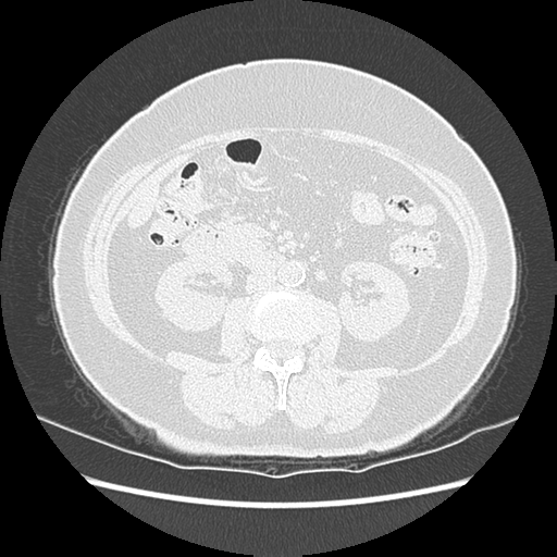 Adenocarcinoma in situ of lung (Radiopaedia 38685-40829 B 273).png