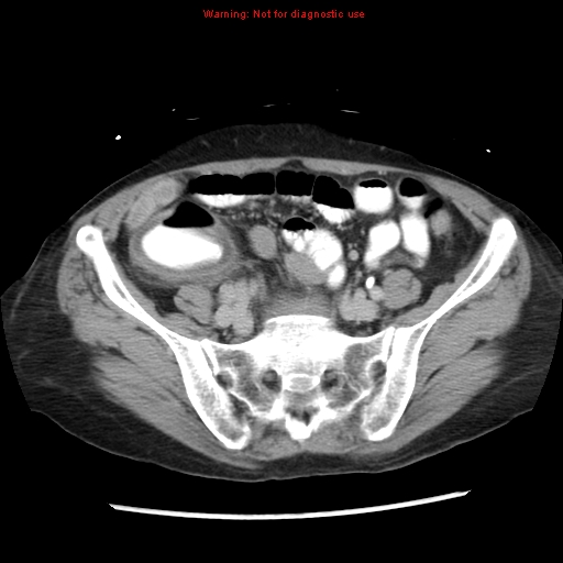 Adenocarcinoma of the colon (Radiopaedia 8191-9039 Axial renal excretory phase 41).jpg