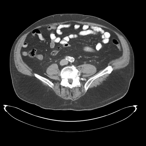 Adenocarcioma of rectum- T1 lesion (Radiopaedia 36921-38547 Axial C+ portal venous phase 57).png