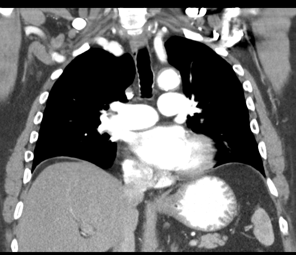 Adenocarcioma of rectum- T1 lesion (Radiopaedia 36921-38547 Coronal C+ arterial phase 33).png
