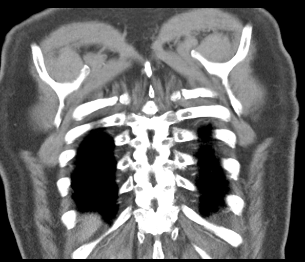 File:Adenocarcioma of rectum- T1 lesion (Radiopaedia 36921-38547 Coronal C+ arterial phase 54).png